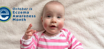 October is Eczema Awareness Month