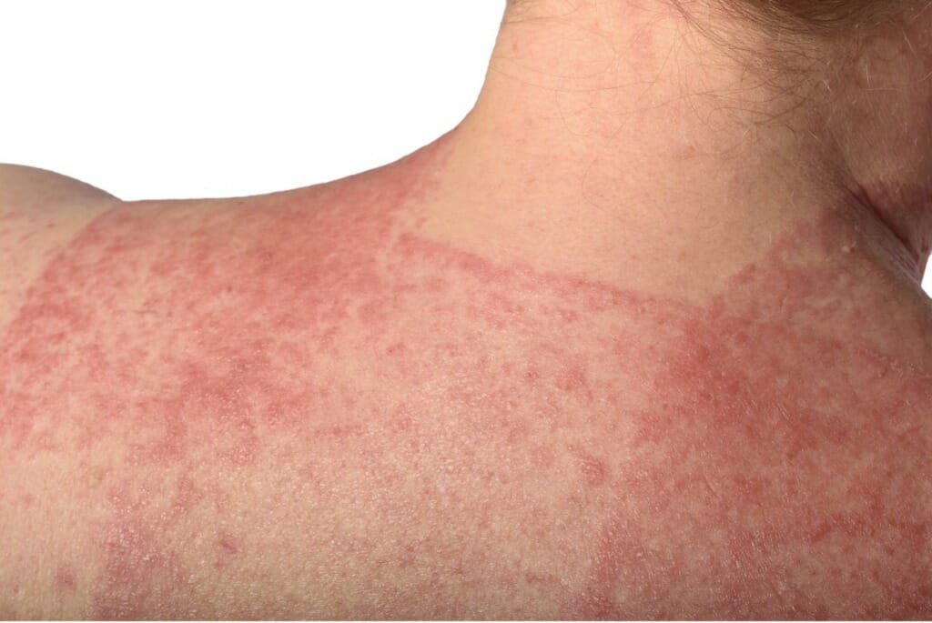 Allergic Reaction Causing Contact Dermatitis