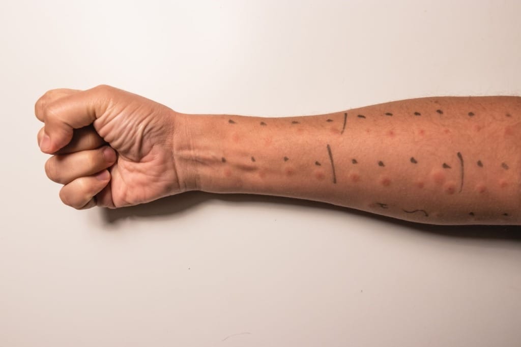 Allergy skin prick test results showing reactions on forearm
